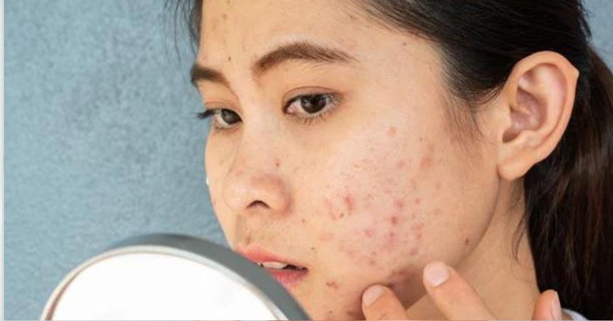 7 aliments qui peuvent causer de l'acné