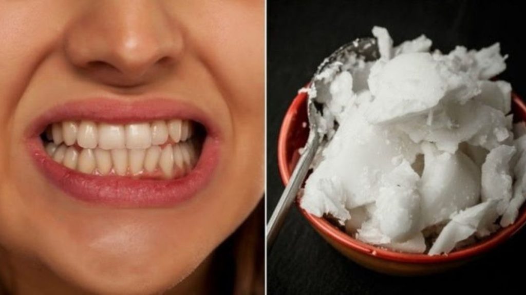 Traitez la mauvaise haleine, le tartre et les plaques dentaires avec de l’huile de coco